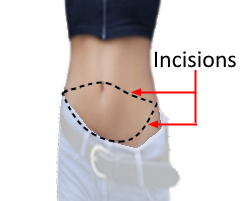 model with cross section of abdominal incisions