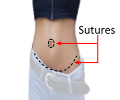 model with cross section of abdominal sutures