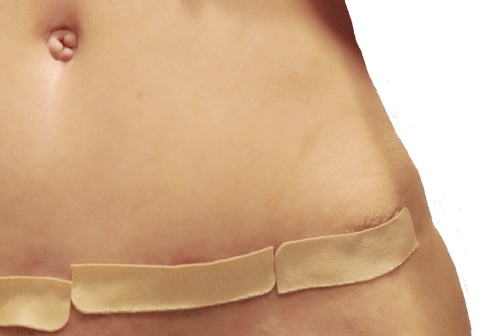 Scaraway tape on surgical site